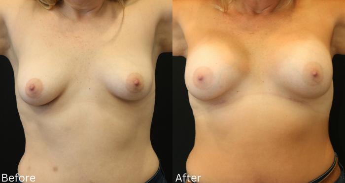 Before & After Breast Augmentation Case 96 View 1 View in Santa Rosa, California