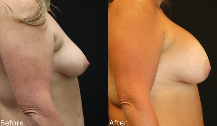 Before & After Breast Augmentation Case 96 View 2 View in Santa Rosa, California