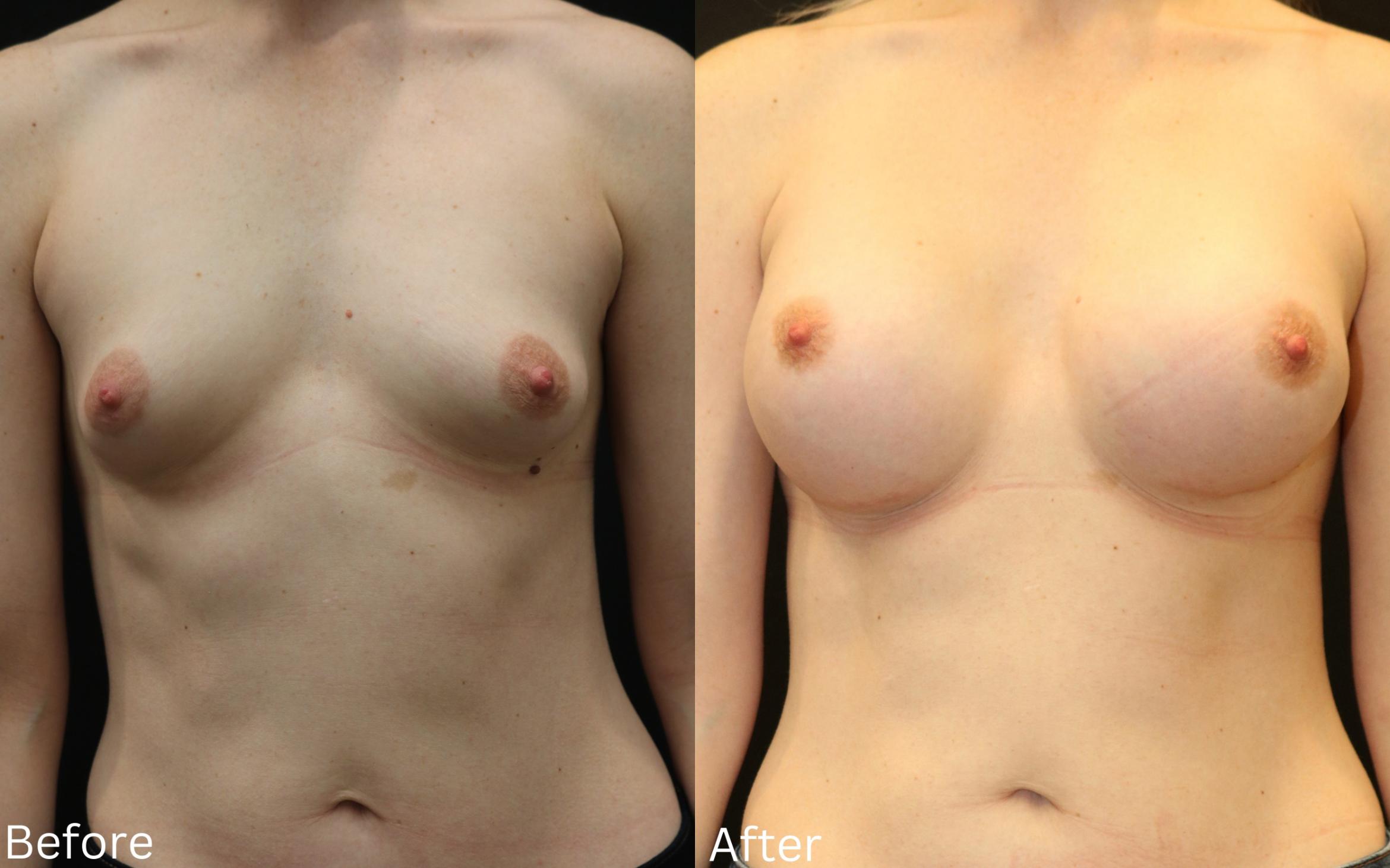 Before & After Breast Augmentation Case 97 View 1 View in Santa Rosa, California