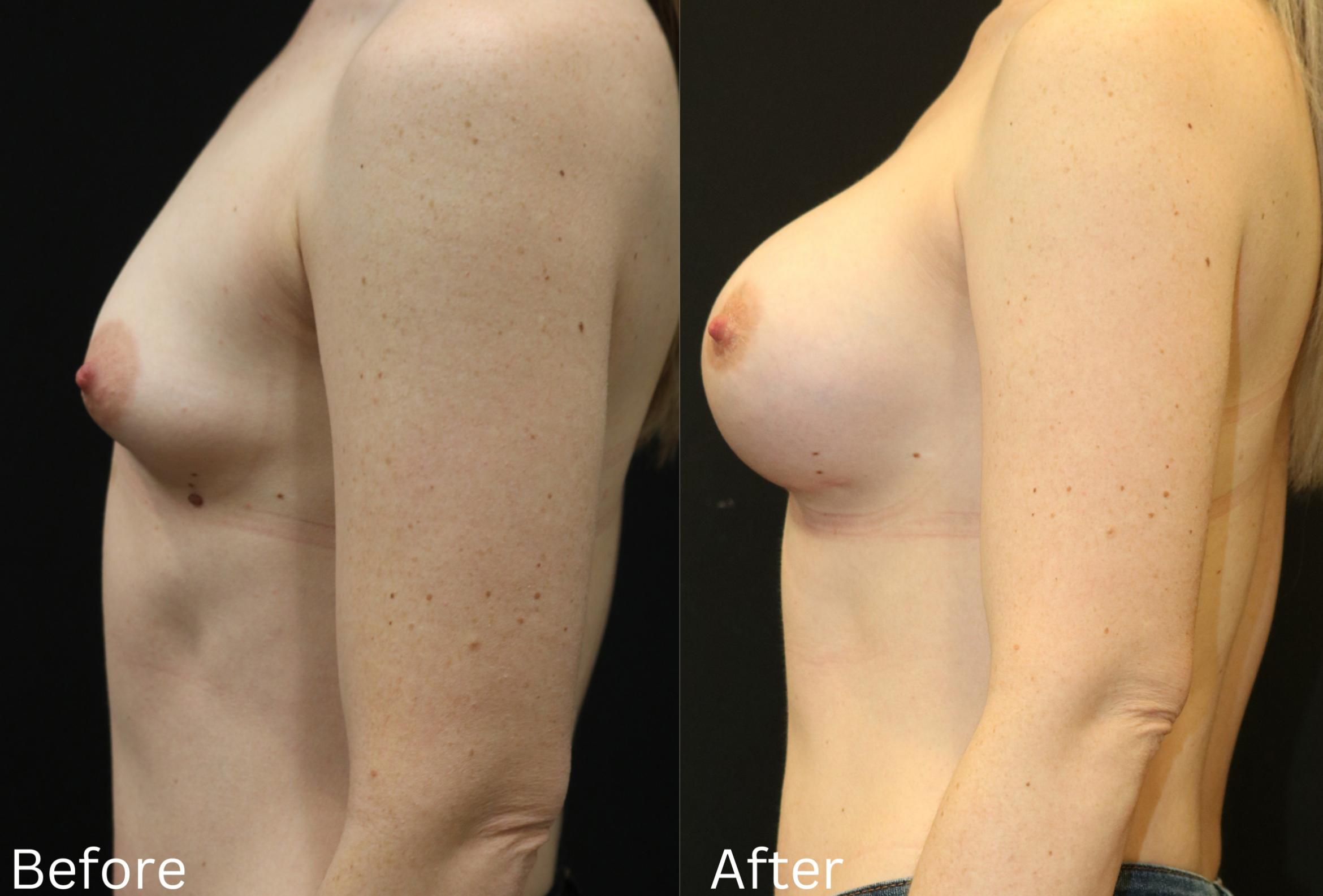 Before & After Breast Augmentation Case 97 View 2 View in Santa Rosa, California