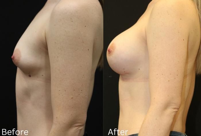 Before & After Breast Augmentation Case 97 View 2 View in Santa Rosa, California