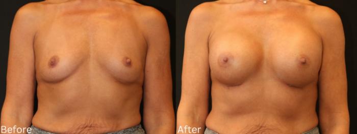 Before & After Breast Augmentation Case 98 View 1 View in Santa Rosa, California