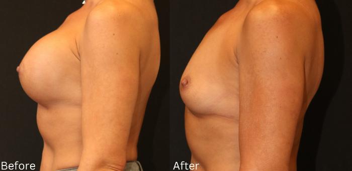 Before & After Breast Augmentation Case 98 View 2 View in Santa Rosa, California