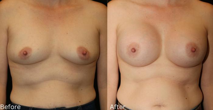 Before & After Breast Augmentation Case 99 View 1 View in Santa Rosa, California