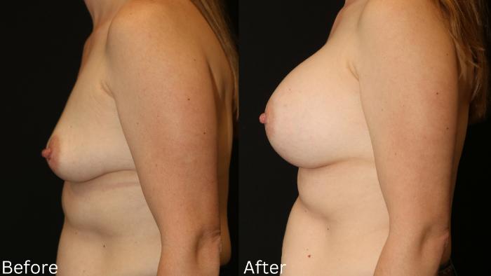 Before & After Breast Augmentation Case 99 View 2 View in Santa Rosa, California