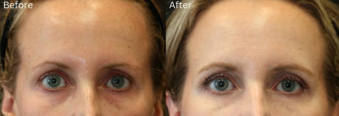 Before & After Brow Lift Case 10 View 1 View in Santa Rosa, California