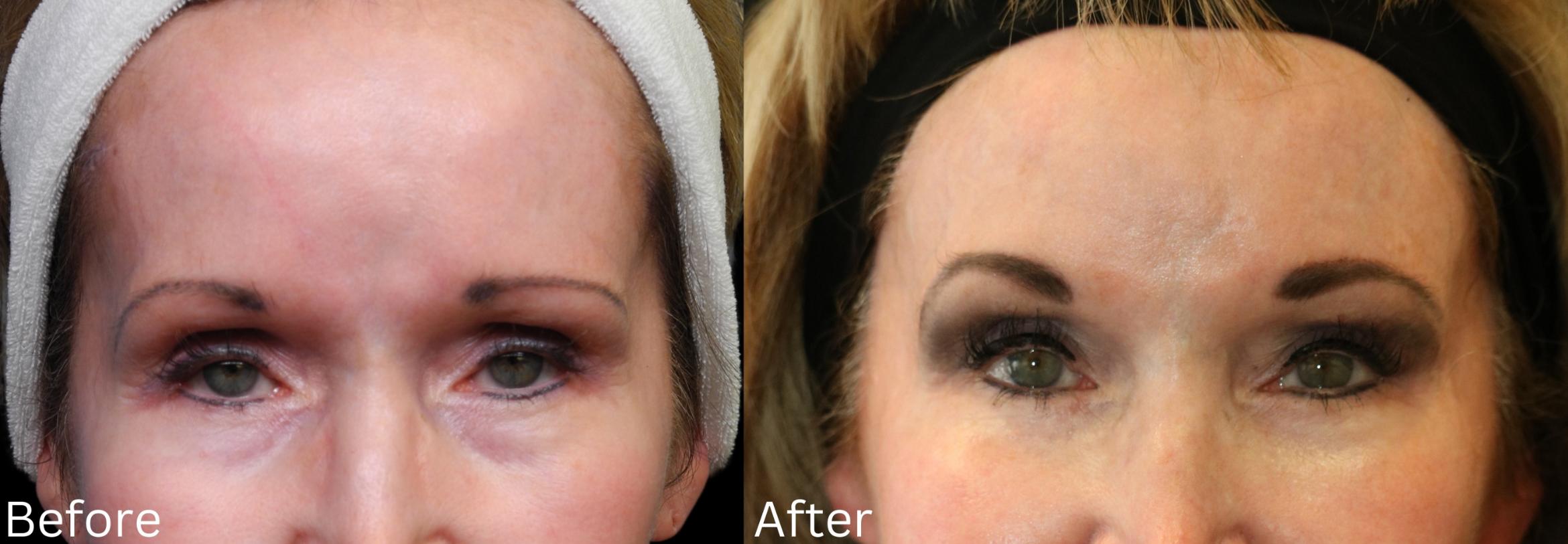 Before & After Brow Lift Case 12 View 1 View in Santa Rosa, California