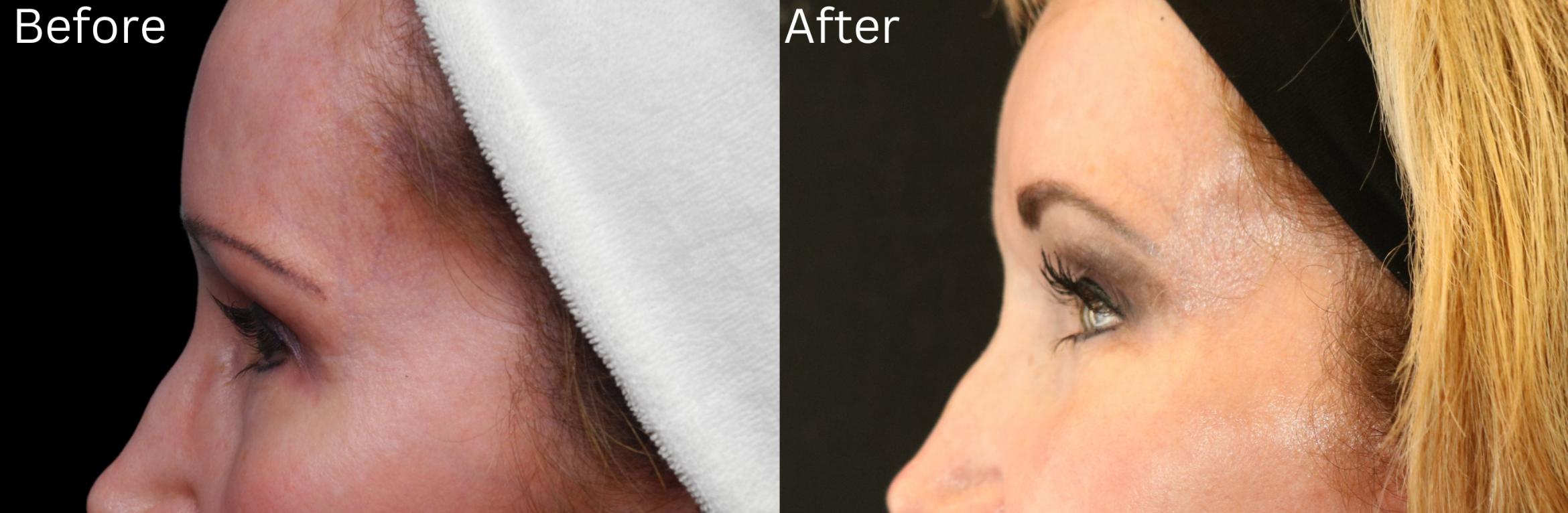 Before & After Brow Lift Case 12 View 2 View in Santa Rosa, California