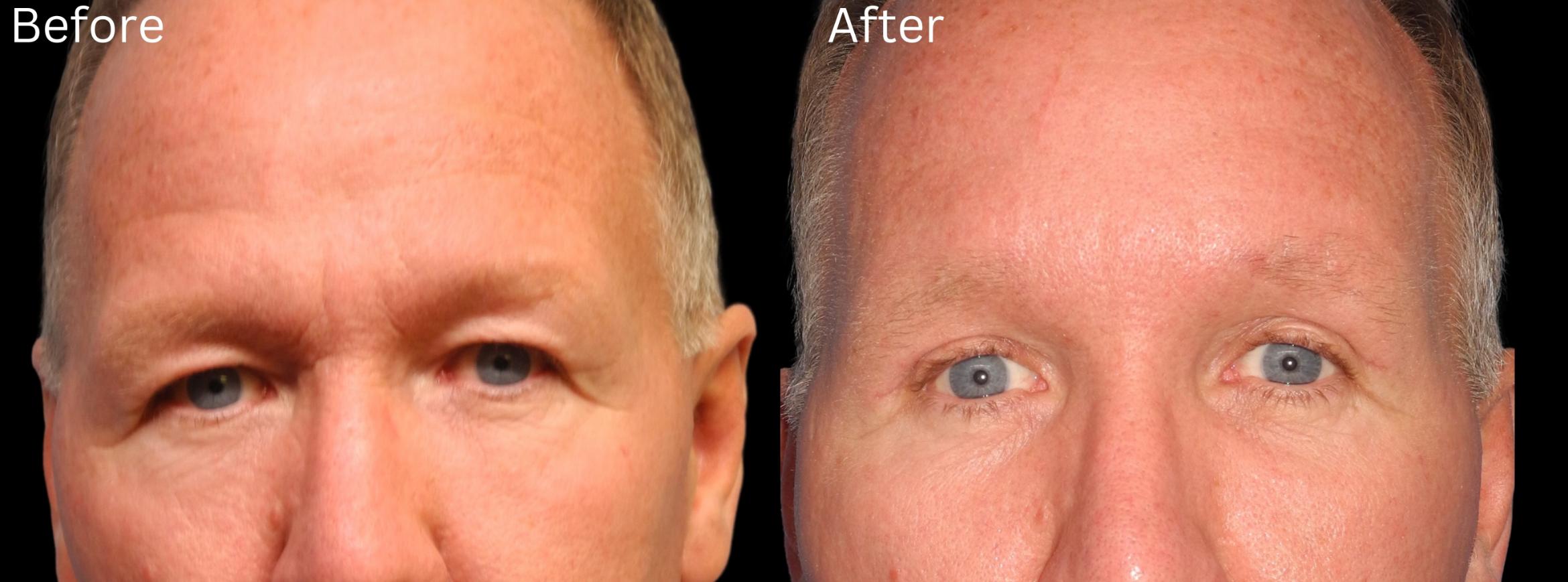 Before & After Brow Lift Case 13 View 1 View in Santa Rosa, California