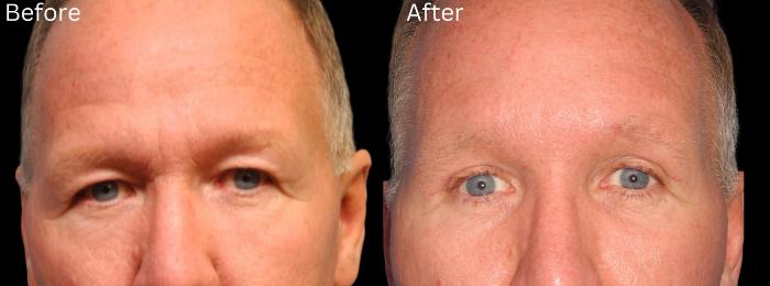 Before & After Brow Lift Case 13 View 1 View in Santa Rosa, California