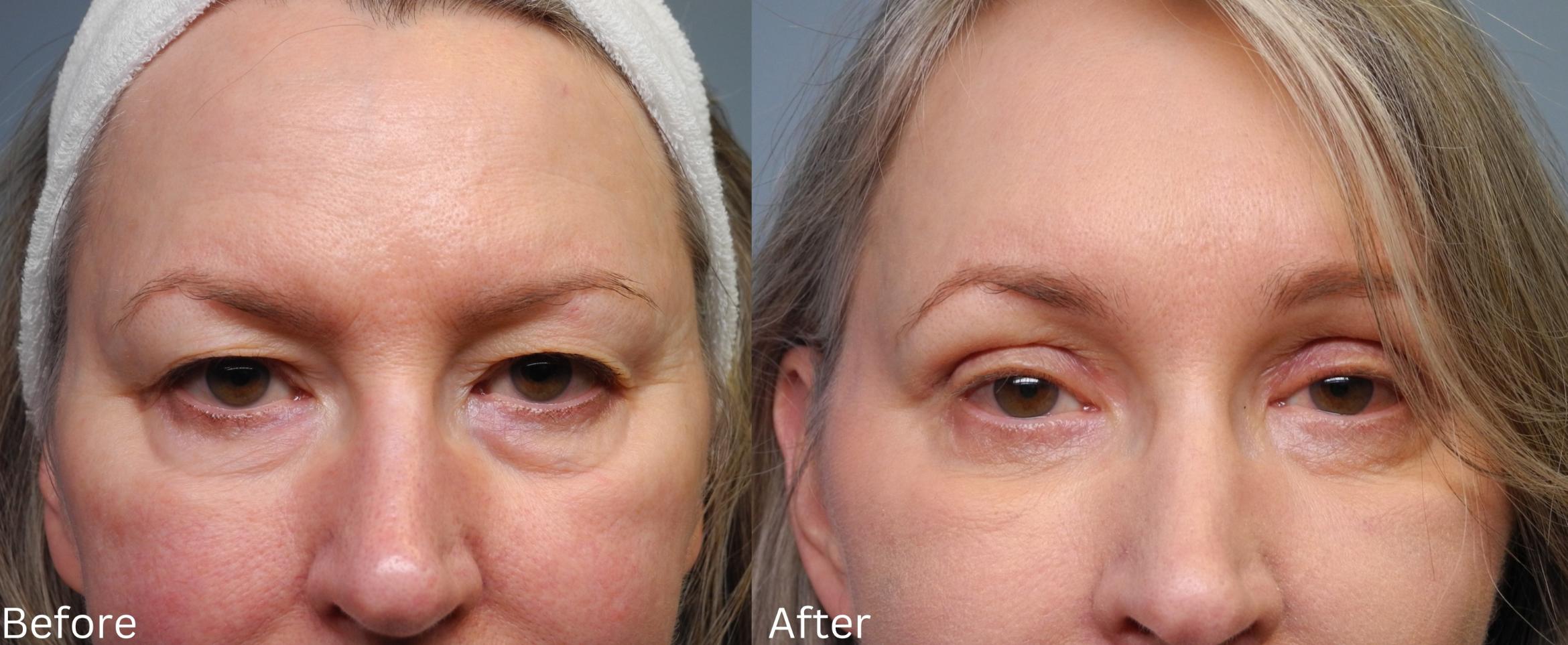 Before & After Brow Lift Case 14 View 1 View in Santa Rosa, California