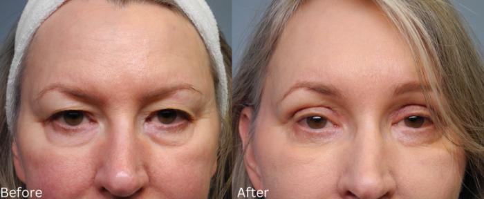 Before & After Brow Lift Case 14 View 1 View in Santa Rosa, California