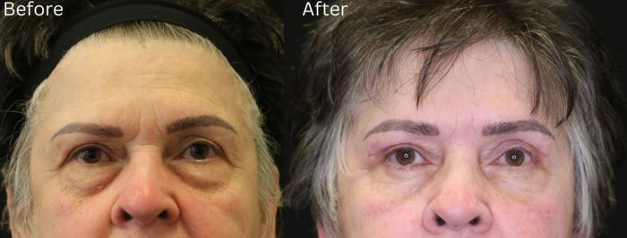 Before & After Brow Lift Case 16 View 1 View in Santa Rosa, California