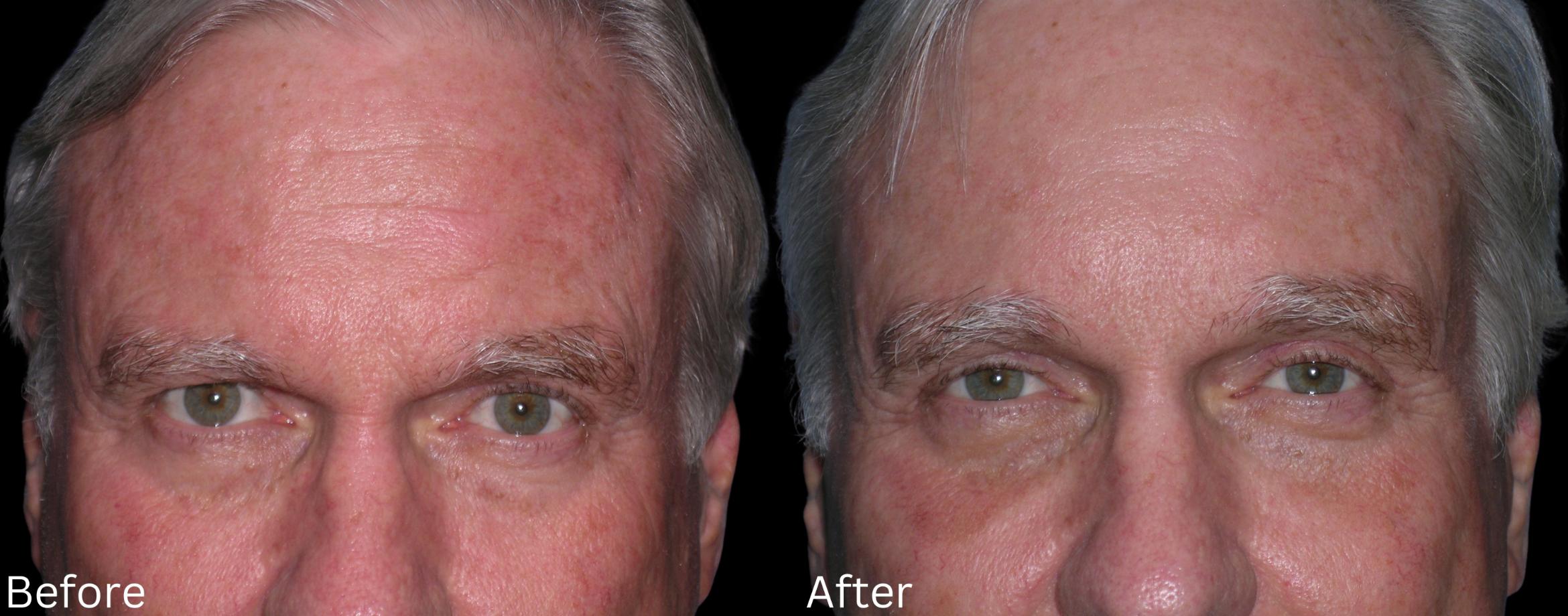 Before & After Brow Lift Case 169 View 1 View in Santa Rosa, California