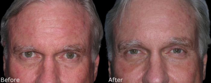 Before & After Brow Lift Case 169 View 1 View in Santa Rosa, California