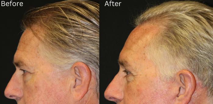 Before & After Brow Lift Case 17 View 1 View in Santa Rosa, California
