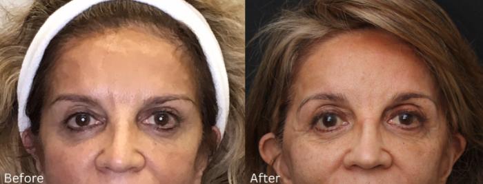 Before & After Brow Lift Case 244 View 1 View in Santa Rosa, California