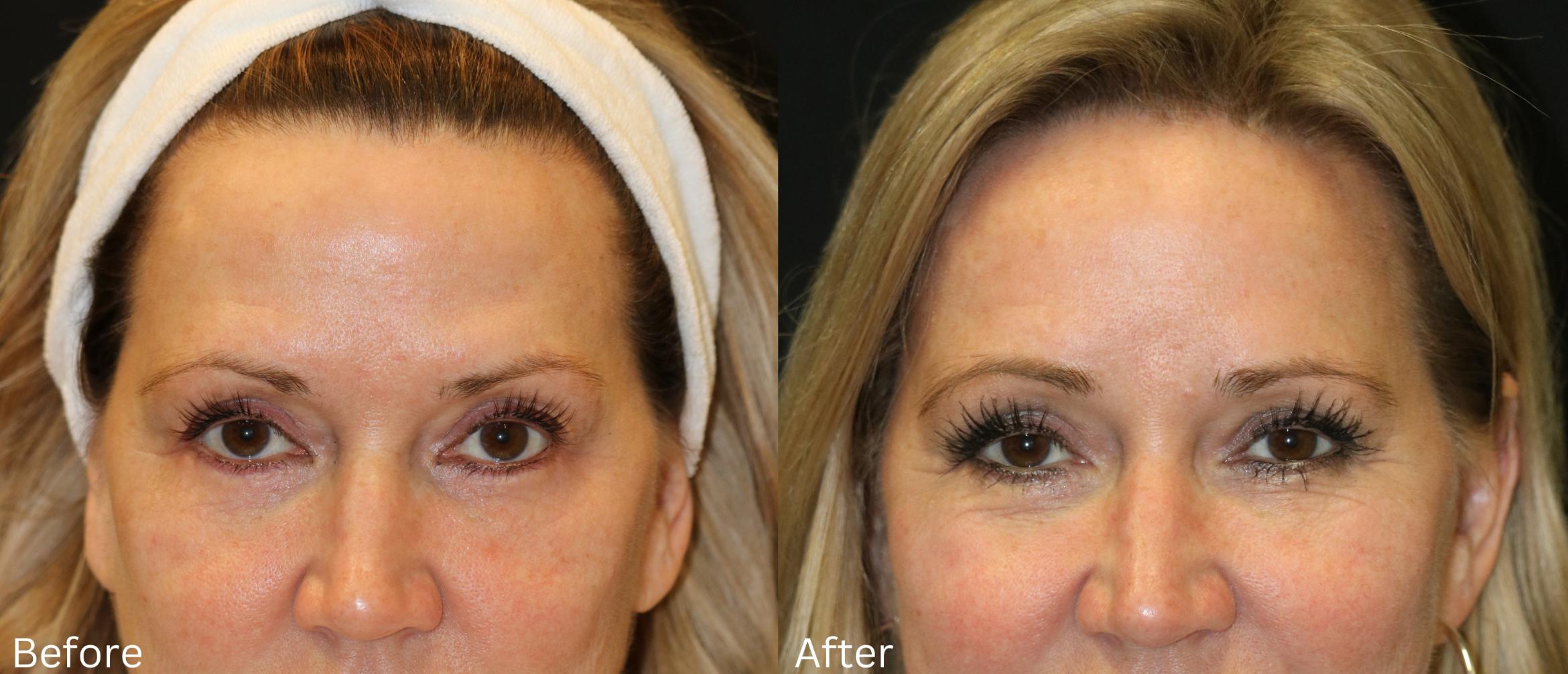 Before & After Brow Lift Case 245 View 1 View in Santa Rosa, California