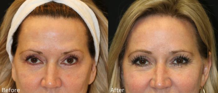 Before & After Brow Lift Case 245 View 1 View in Santa Rosa, California