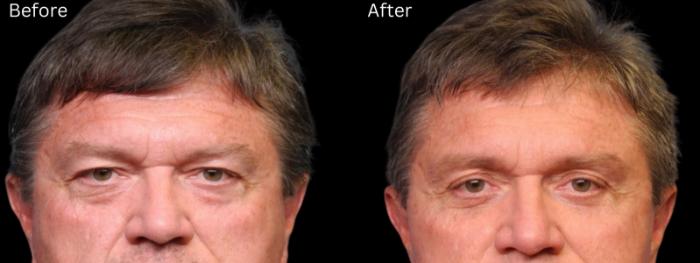 Before & After Brow Lift Case 246 View 1 View in Santa Rosa, California