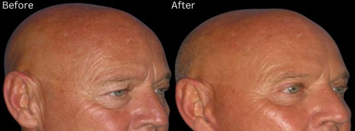 Before & After Brow Lift Case 247 View 1 View in Santa Rosa, California