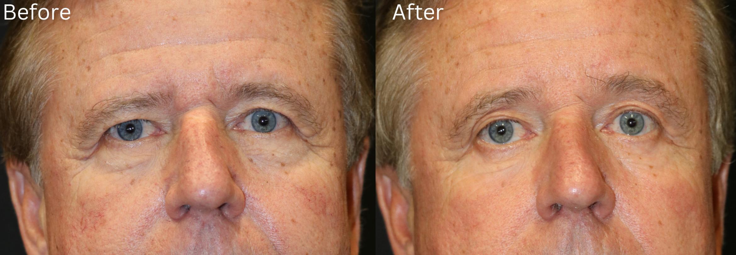 Before & After Brow Lift Case 8 View 1 View in Santa Rosa, California