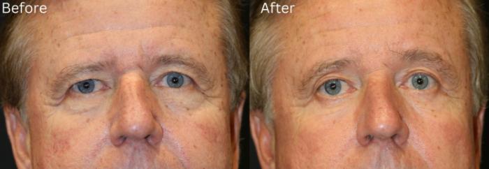 Before & After Brow Lift Case 8 View 1 View in Santa Rosa, California