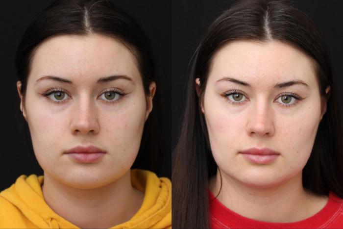 Before & After Buccal Fat Removal Case 381 View 1 View in Santa Rosa, California