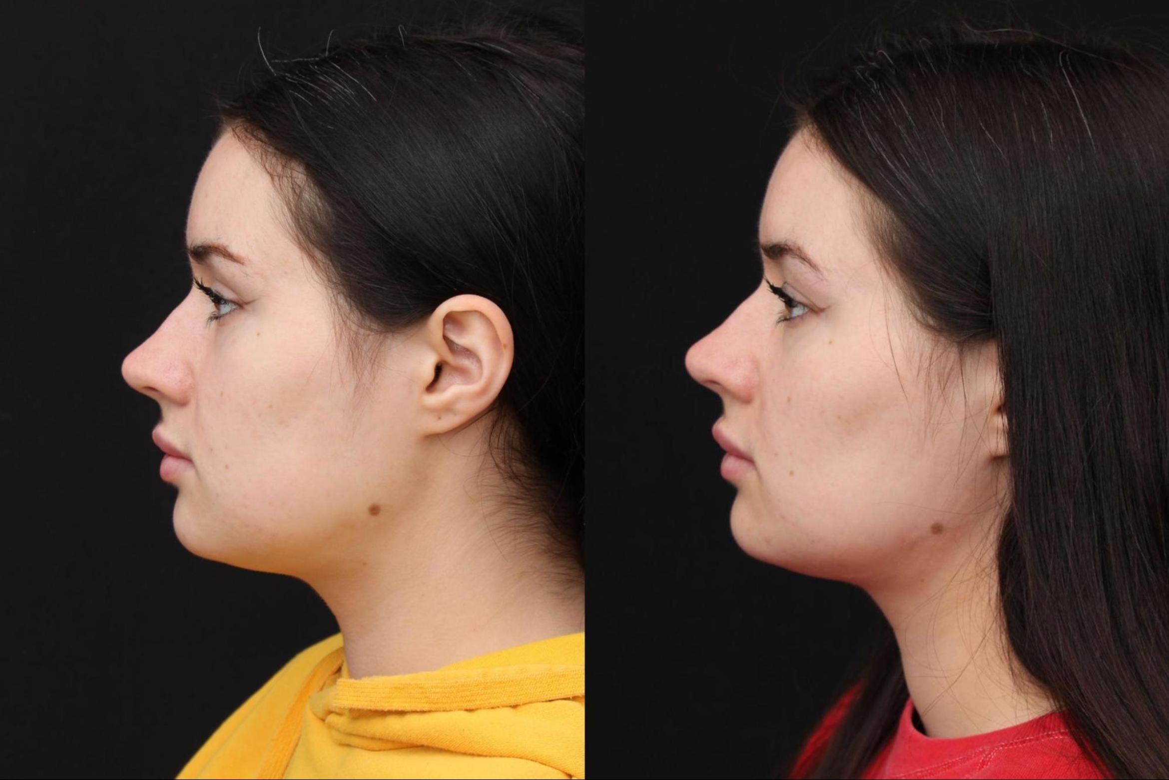 Before & After Buccal Fat Removal Case 381 View 2 View in Santa Rosa, California