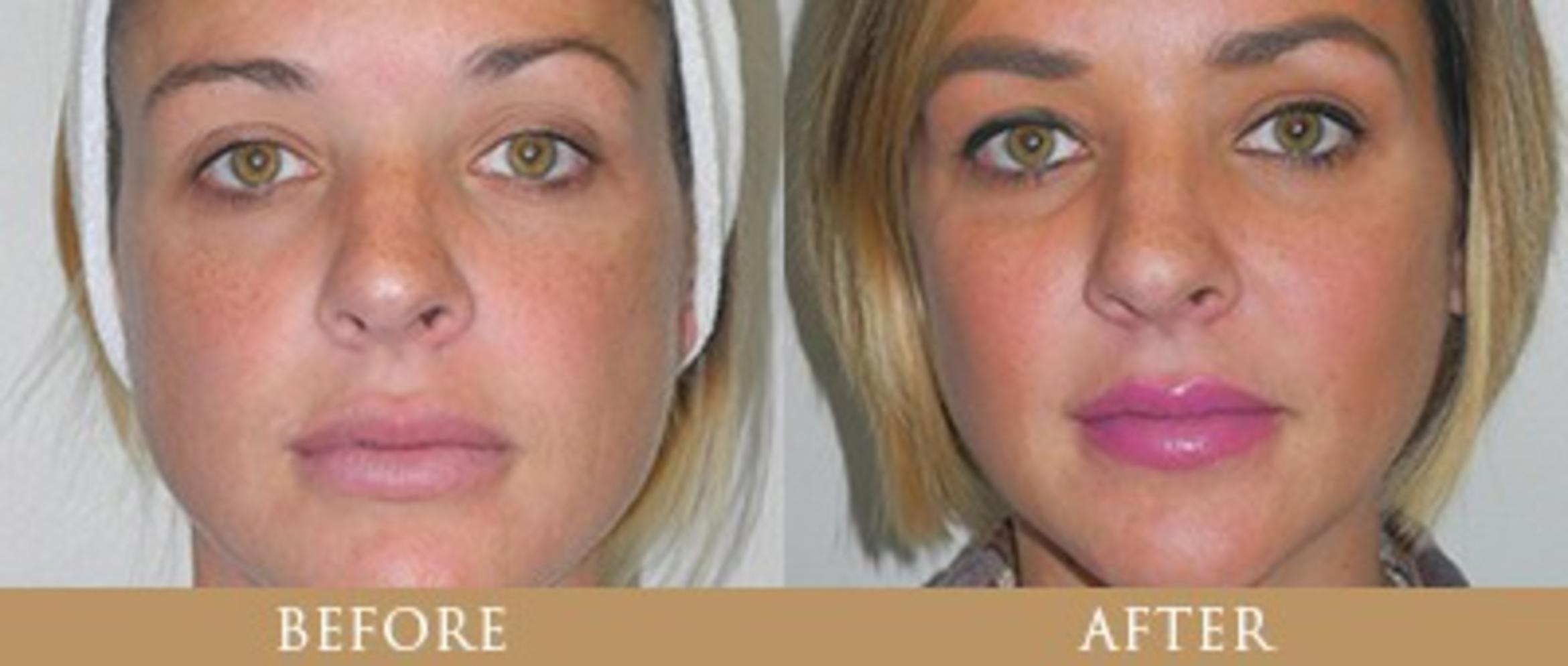 Before & After Cheek Implants Case 18 View 1 View in Santa Rosa, California