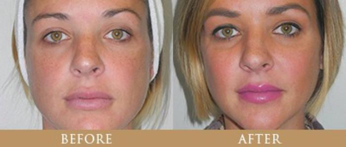 Before & After Cheek Implants Case 18 View 1 View in Santa Rosa, California
