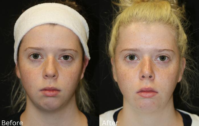 Before & After Chin Implants Case 165 View 1 View in Santa Rosa, California