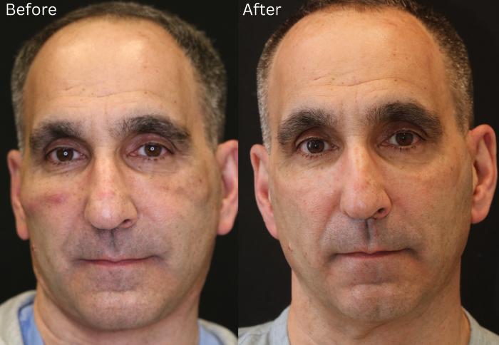 Before & After Chin Implants Case 248 View 1 View in Santa Rosa, California