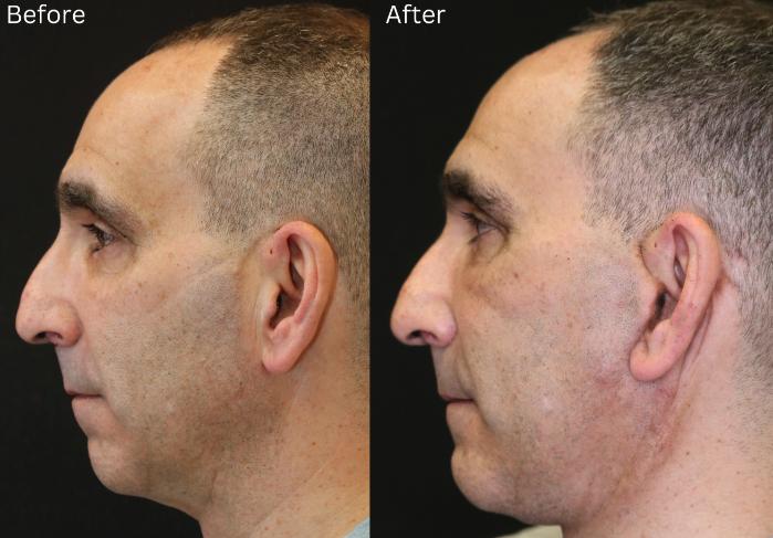 Before & After Chin Implants Case 248 View 2 View in Santa Rosa, California