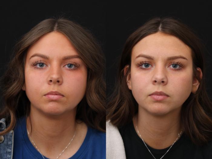 Before & After Chin Implants Case 418 Front View in Santa Rosa, California