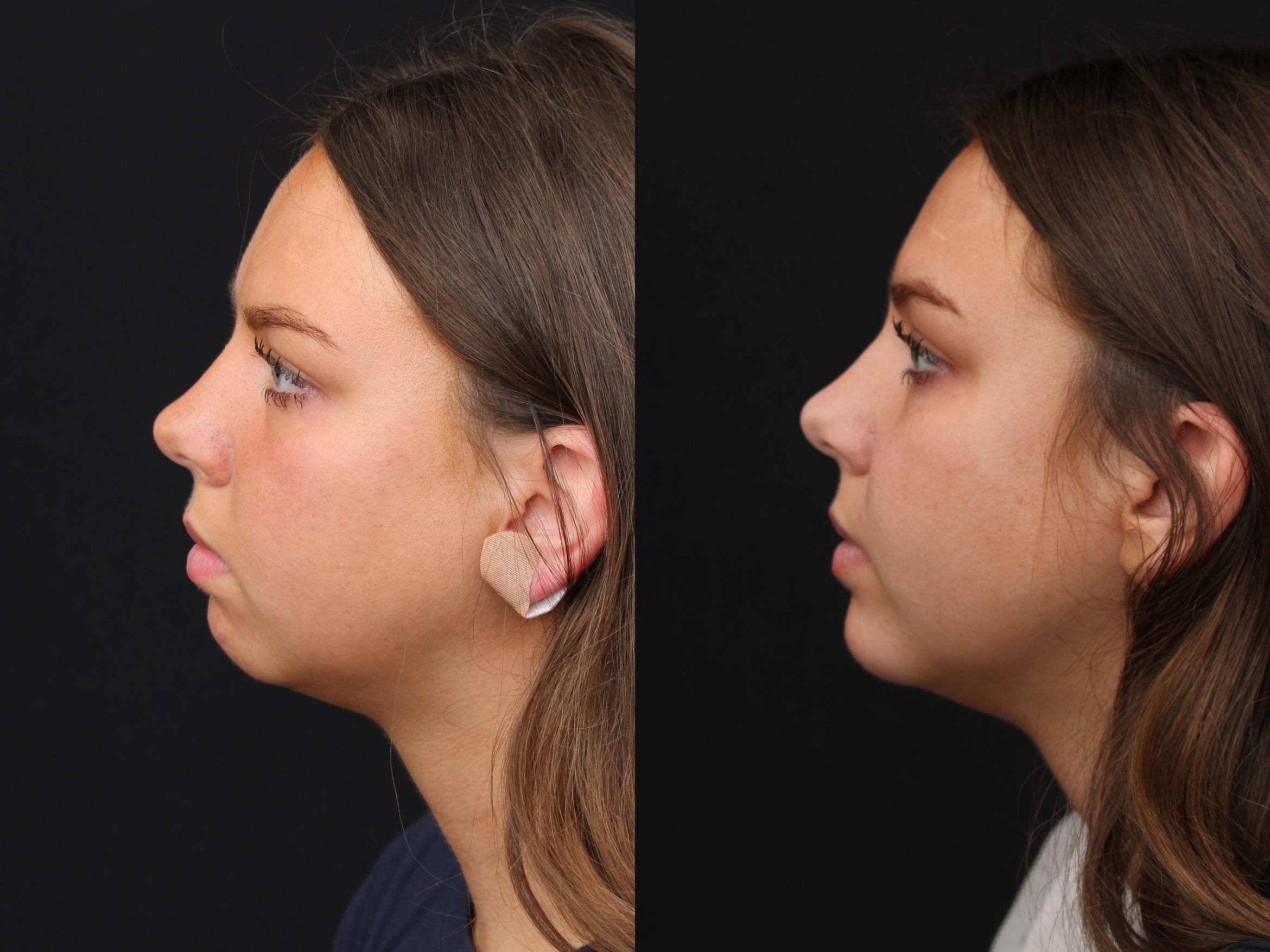 Before & After Chin Implants Case 418 Left Side View in Santa Rosa, California
