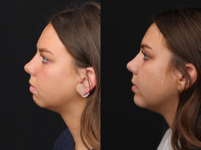 Before & After Chin Implants Case 418 Left Side View in Santa Rosa, California