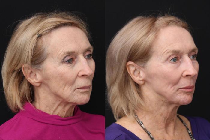 Before & After CO2 Laser Resurfacing Case 402 View 1 View in Santa Rosa, California
