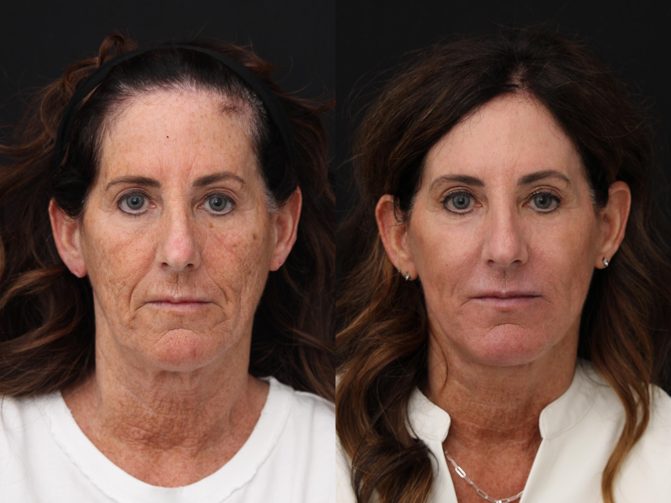 Before & After CO2 Laser Resurfacing Case 428 Front View in Santa Rosa, California