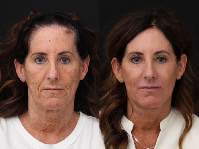 Before & After CO2 Laser Resurfacing Case 428 Front View in Santa Rosa, California