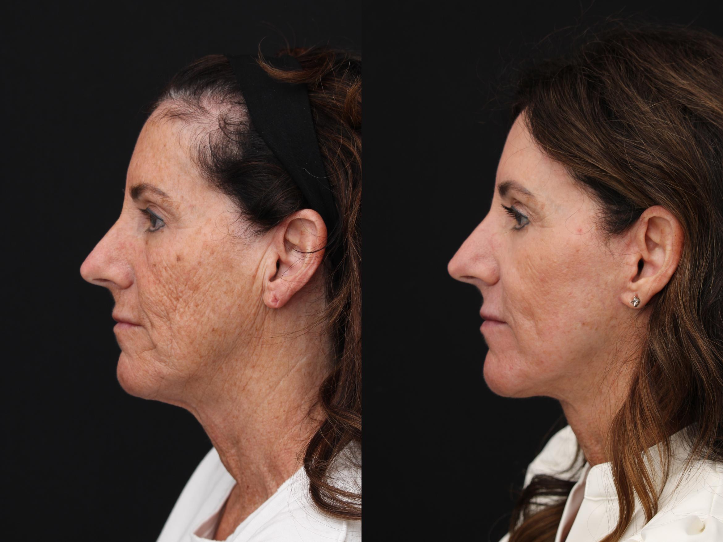 Before & After CO2 Laser Resurfacing Case 428 Left Side View in Santa Rosa, California