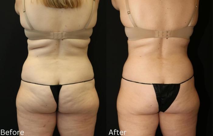 Before & After CoolSculpting Case 178 View 1 View in Santa Rosa, California