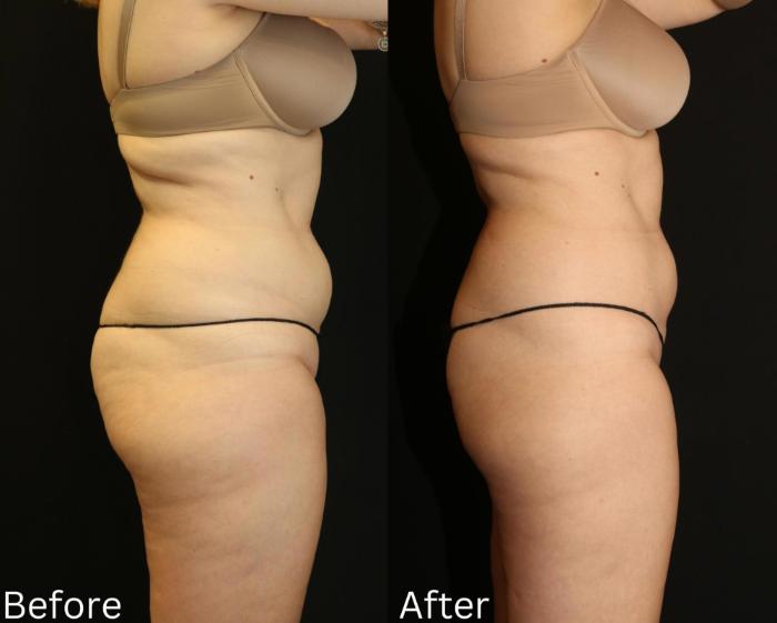Before & After CoolSculpting Case 178 View 2 View in Santa Rosa, California