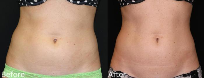 Before & After CoolSculpting Case 179 View 1 View in Santa Rosa, California