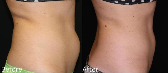 Before & After CoolSculpting Case 179 View 2 View in Santa Rosa, California