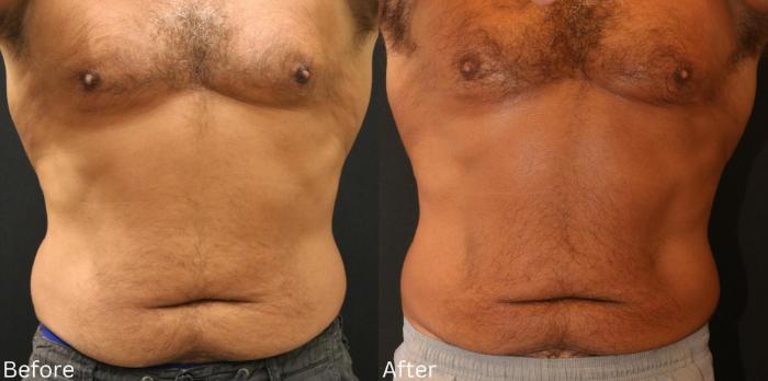 Before & After CoolSculpting Case 180 View 1 View in Santa Rosa, California