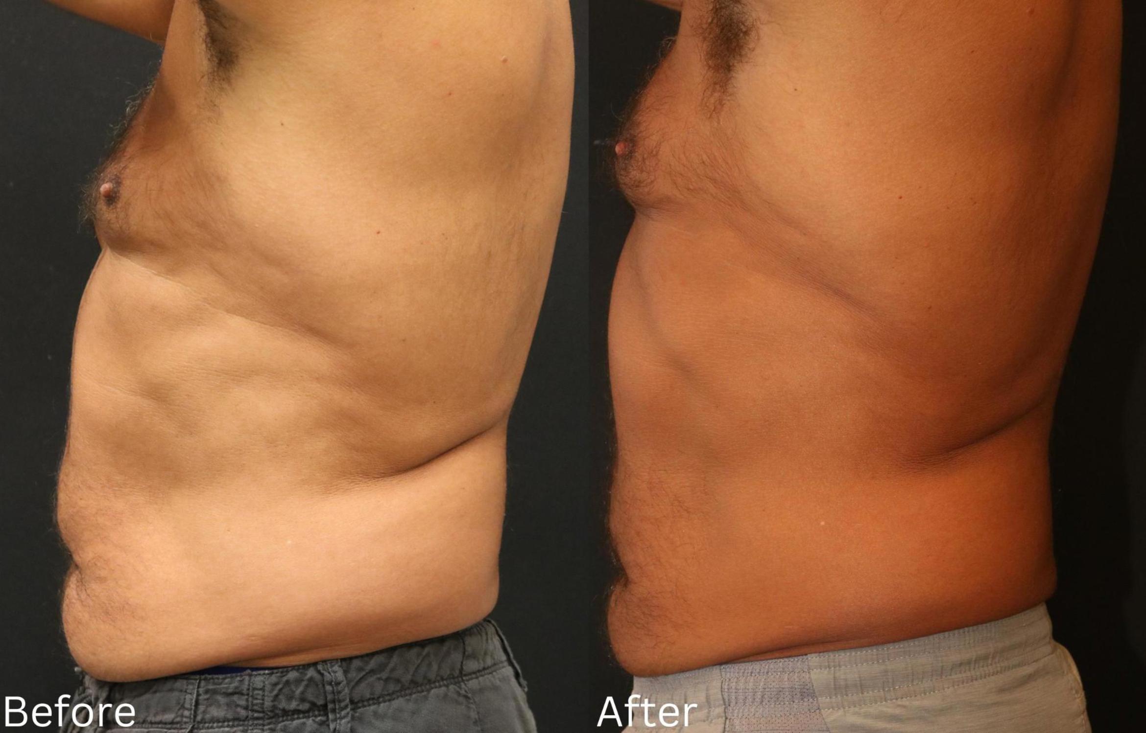 Before & After CoolSculpting Case 180 View 2 View in Santa Rosa, California