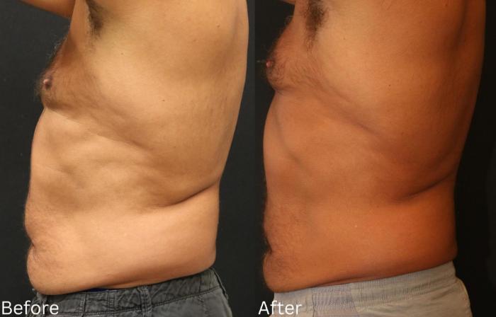 Before & After CoolSculpting Case 180 View 2 View in Santa Rosa, California