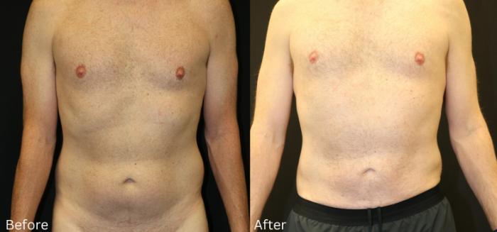 Before & After CoolSculpting Case 223 View 1 View in Santa Rosa, California