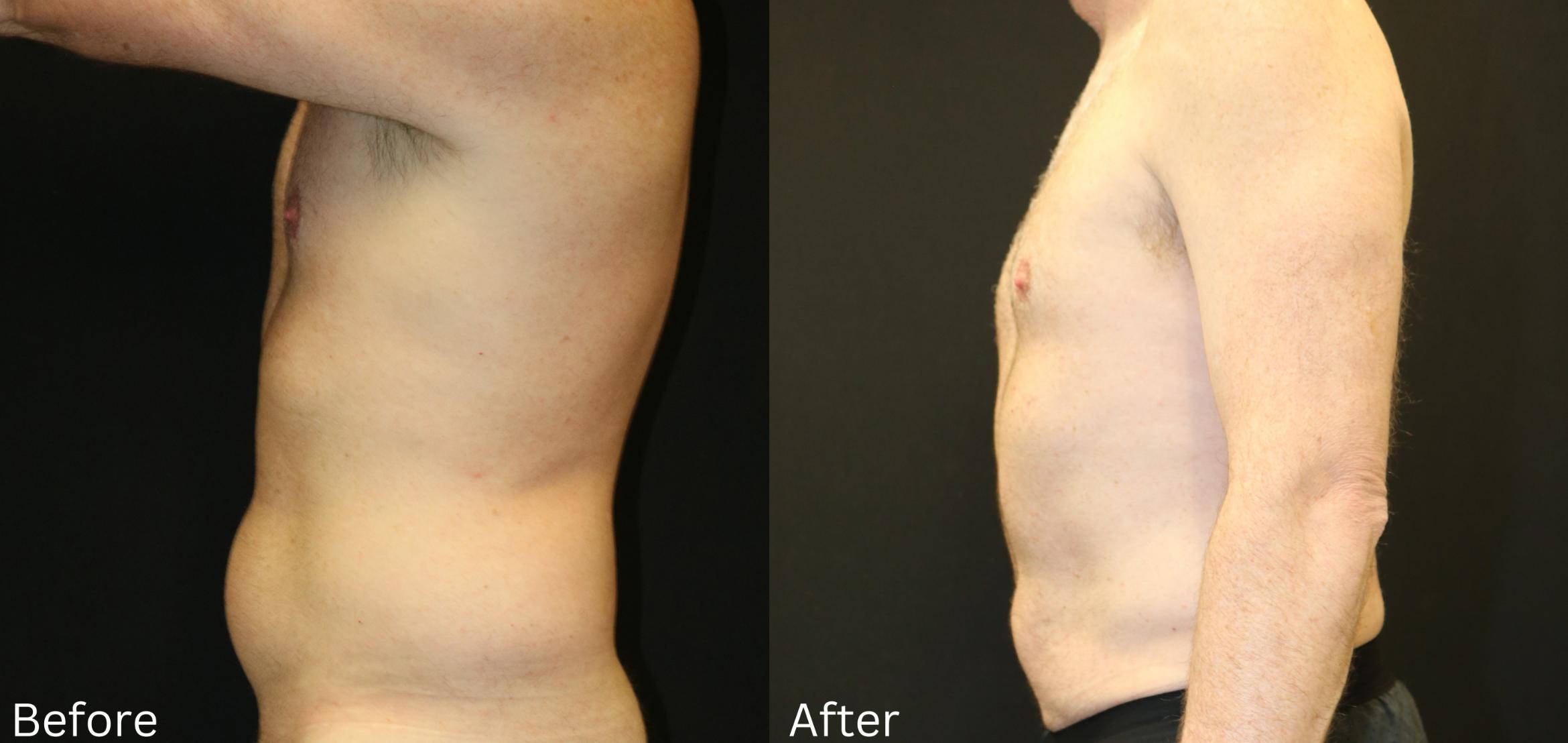 Before & After CoolSculpting Case 223 View 2 View in Santa Rosa, California